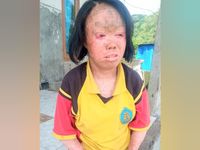 Derita Penyakit Kulit Puluhan Tahun, Putu Malini Butuh Uluran Tangan Sakit Kulit