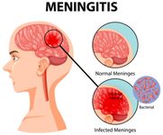 10 Warga Buleleng Suspek Meningitis, Ada Riwayat Mengonsumsi Lawar meningitis
