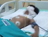Bocah 7 Tahun Terluka Bakar Saat Bakar Sampah di Karangasem Terbakar