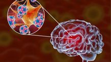 Positif Meningitis, Dua Pasien Masih Dirawat di Rumah Sakit Meningitis