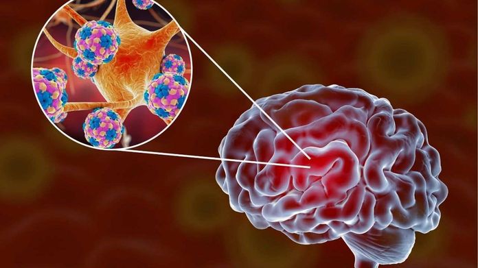 Meningitis