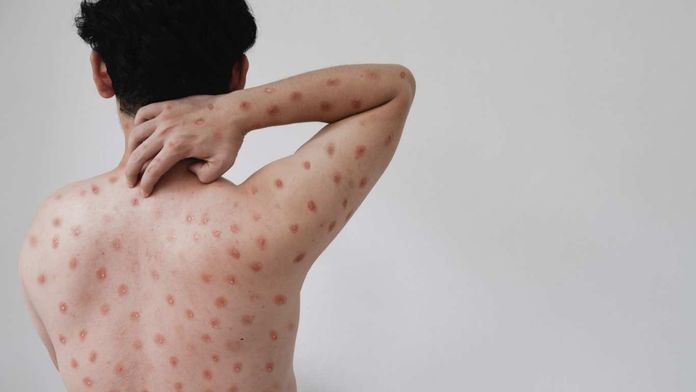 MPOX