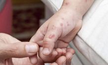 Herpes Zoster: Risiko, Gejala, dan Pencegahan pada Orang Dewasa di Bali Herpes