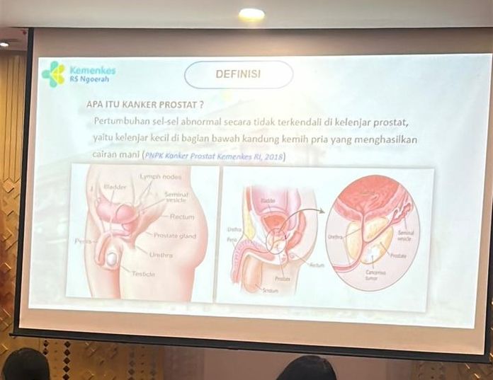 Waspadai Kanker Prostat, Penyakit Ganas yang Mengintai Pria