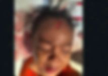 Anjing Liar Serang Balita di Karangasem, Korban Dapat 6 Jahitan di Dahi Anjing Liar Serang Balita di Karangasem, Korban Dapat 6 Jahitan di Dahi